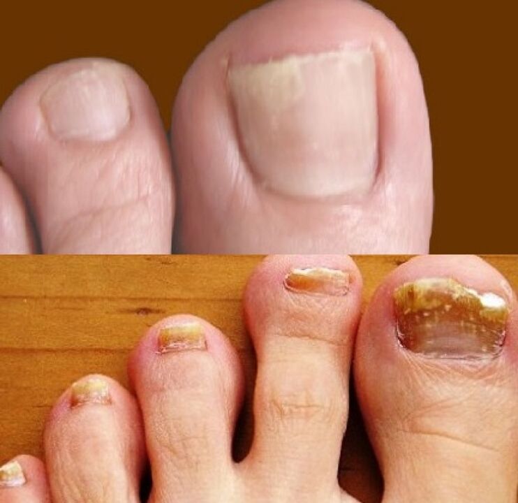 gljivice noktiju na nogama