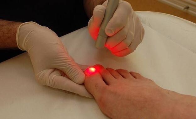 laserski tretman gljivica na noktima na nogama