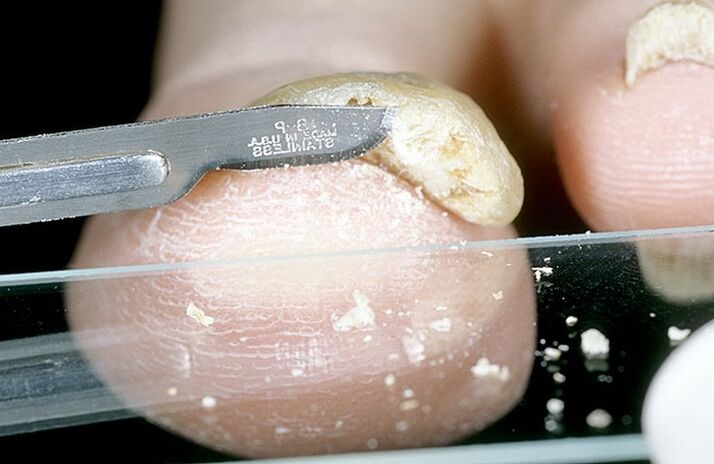 struganje noktiju za dijagnosticiranje gljivica