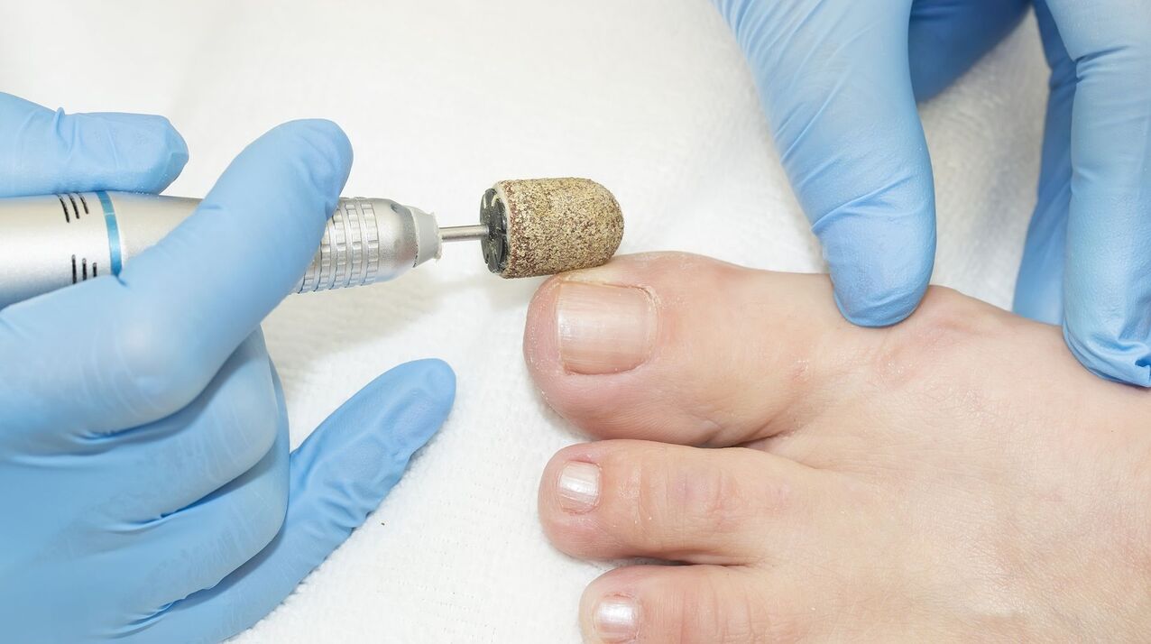 hardversko liječenje gljivica na noktima na nogama