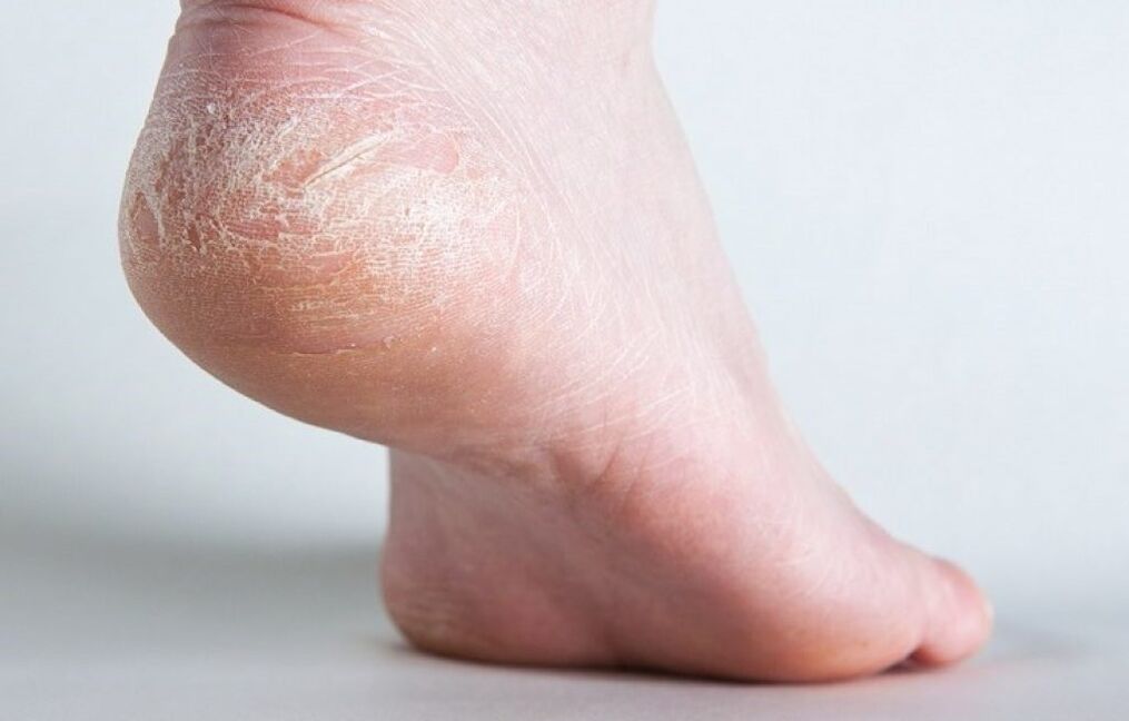 gljivice kože na nozi kako liječiti