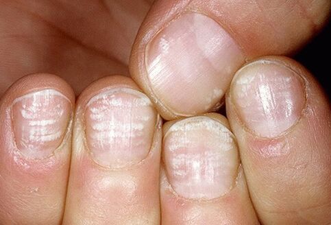 gljivična infekcija ploče nokta