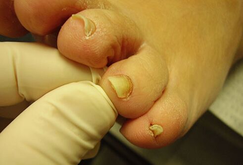 žuti nokti na nogama s gljivicom