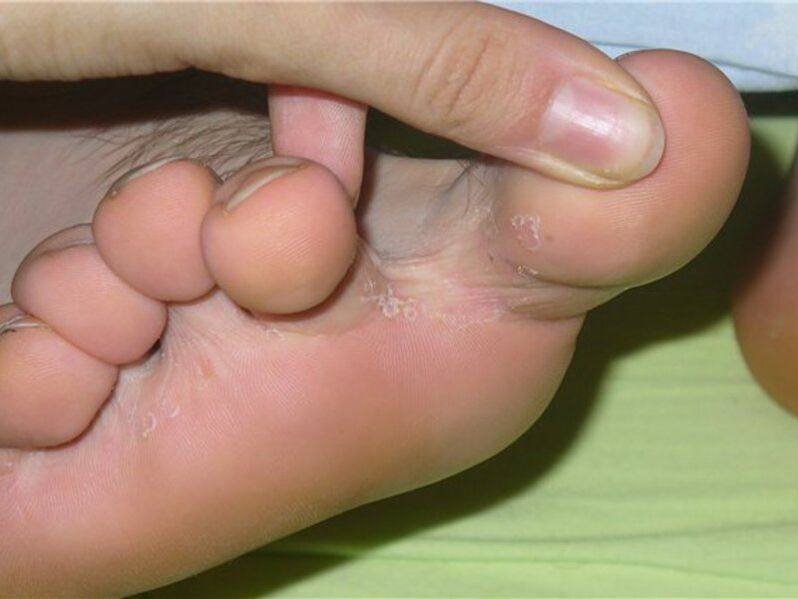simptomi gljivica na nožnim prstima