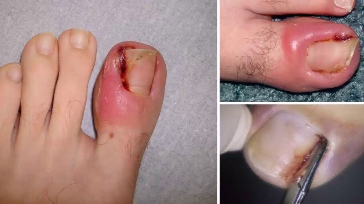 komplikacije gljivica na noktima