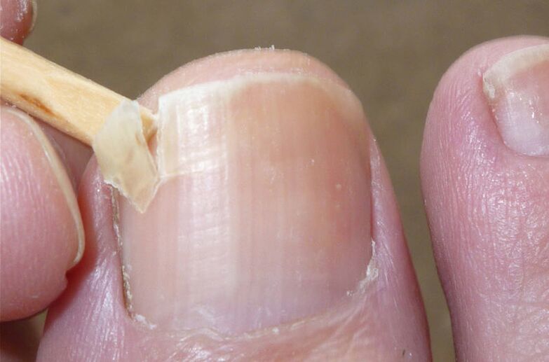 Oštećeni nokti faktor su rizika za gljivičnu infekciju