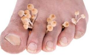 Onikomikoza noktiju na nogama
