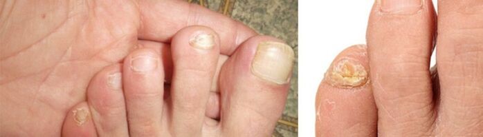 fotografija manifestacija gljivica na noktima nogu
