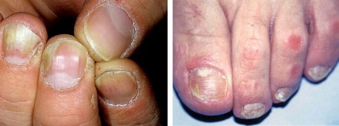manifestacije gljivične infekcije na noktima