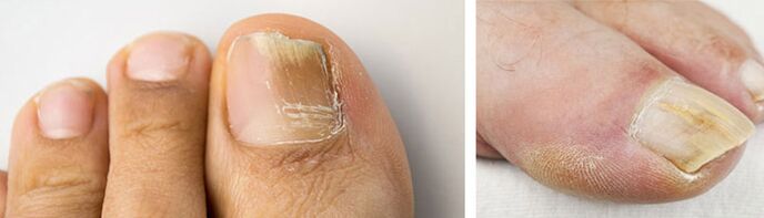 fotografija gljivične infekcije na noktu velikog prsta