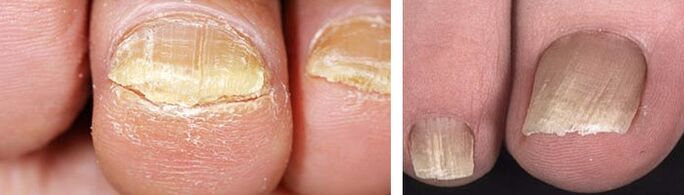 oštećenje noktiju gljivičnom infekcijom
