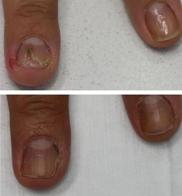 gljivična infekcija noktiju na nogama