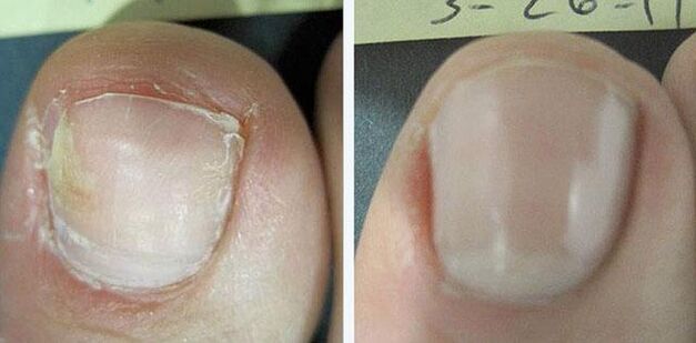 prije i poslije liječenja gljivica na noktima