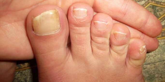 oštećenje noktiju na nogama gljivicama
