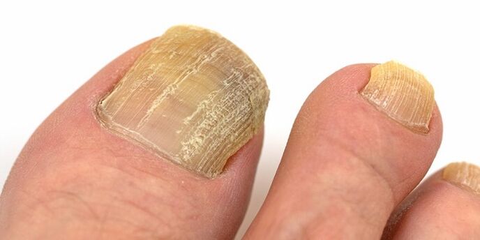 oštećenje noktiju s uznapredovalom gljivičnom infekcijom