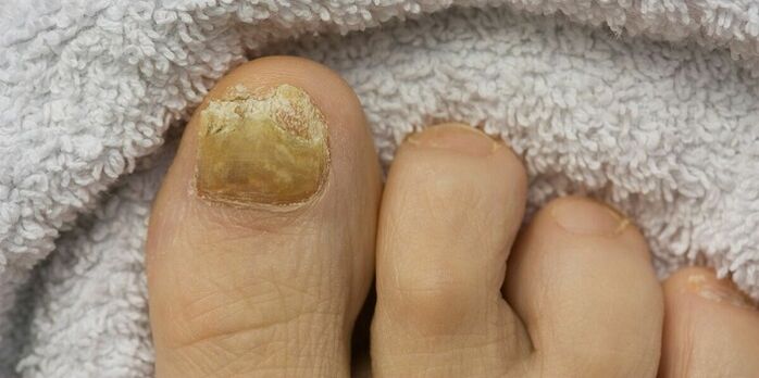 žuti nokat na nozi s gljivičnom infekcijom