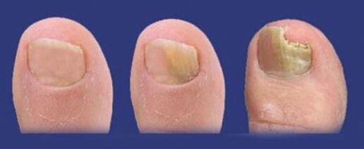 faze razvoja gljive na noktima nogu