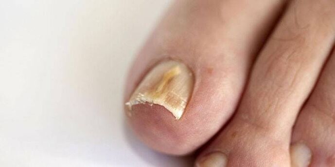 gljiva na noktima noktiju