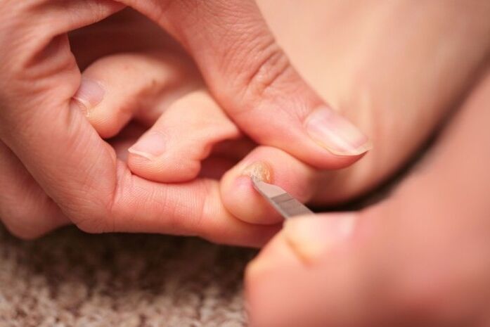 Protugljivični tretman noktiju
