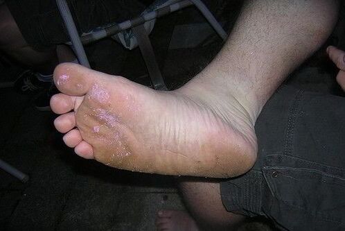 gljivično stopalo