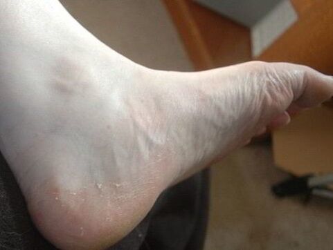 ljuštenje stopala noge kao znak gljivične infekcije