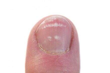početna faza infekcije gljivicama noktiju