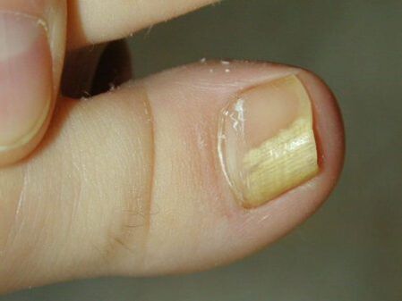 subungualna gljiva nokta